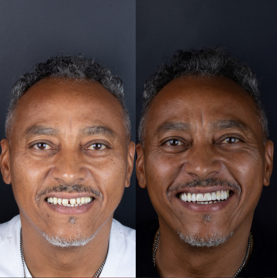 Prótese Dentária