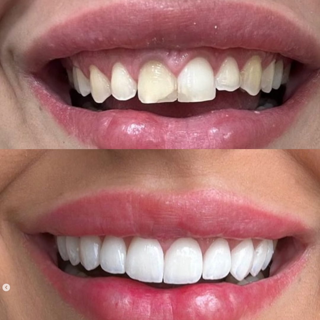 Clareamento e Estética
