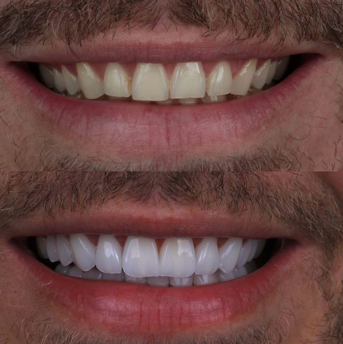 Lentes de Contato