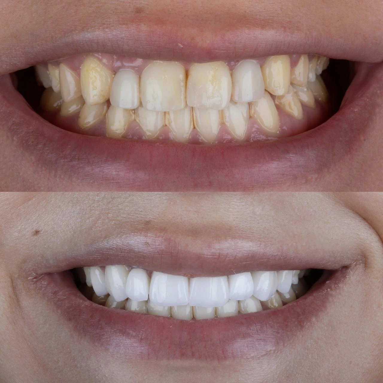 Facetas em Porcelana